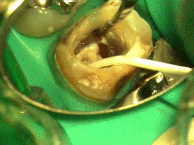 歯根のヒビ割れの修復 充填後の修正2015.06.04.gif